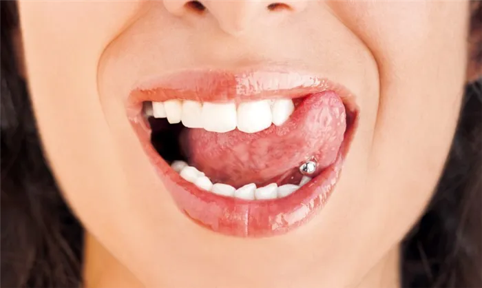 В 15-20% случаев пирсинг языка повышает хрупкость и уязвимость зубов