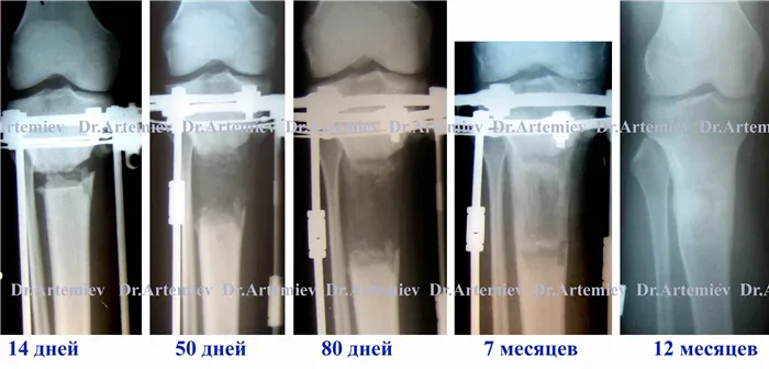 7 см от регенерации большеберцовой кости до удлинения большеберцовой кости