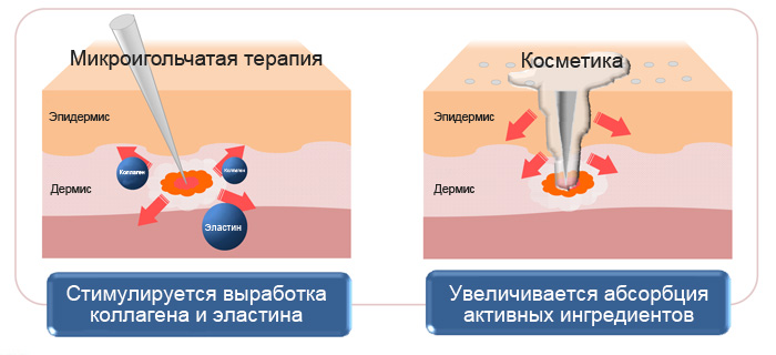 Воздействие мезороллера фото