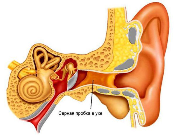 Скопление серы в ухе