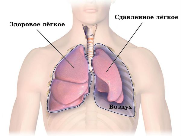 Сдавленное лёгкое при спонтанном пневмотораксе